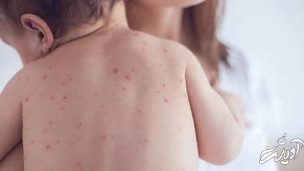 آبله مرغان در کودکان زیر یک سال شکل جوشهای ابله مرغان